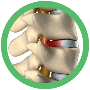 disc herniation model